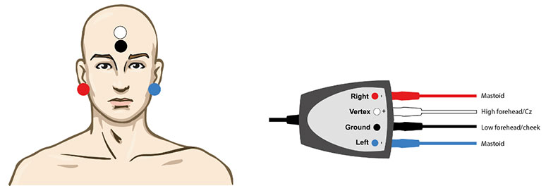Man with right electrode on the right mastoid, vertex electrode on the high forehead, ground electrode on the low forehead, and left electrode on the left mastoid. Right electrode is red. Vertex electrode is white. Ground electrode is black. Left electrode is blue.