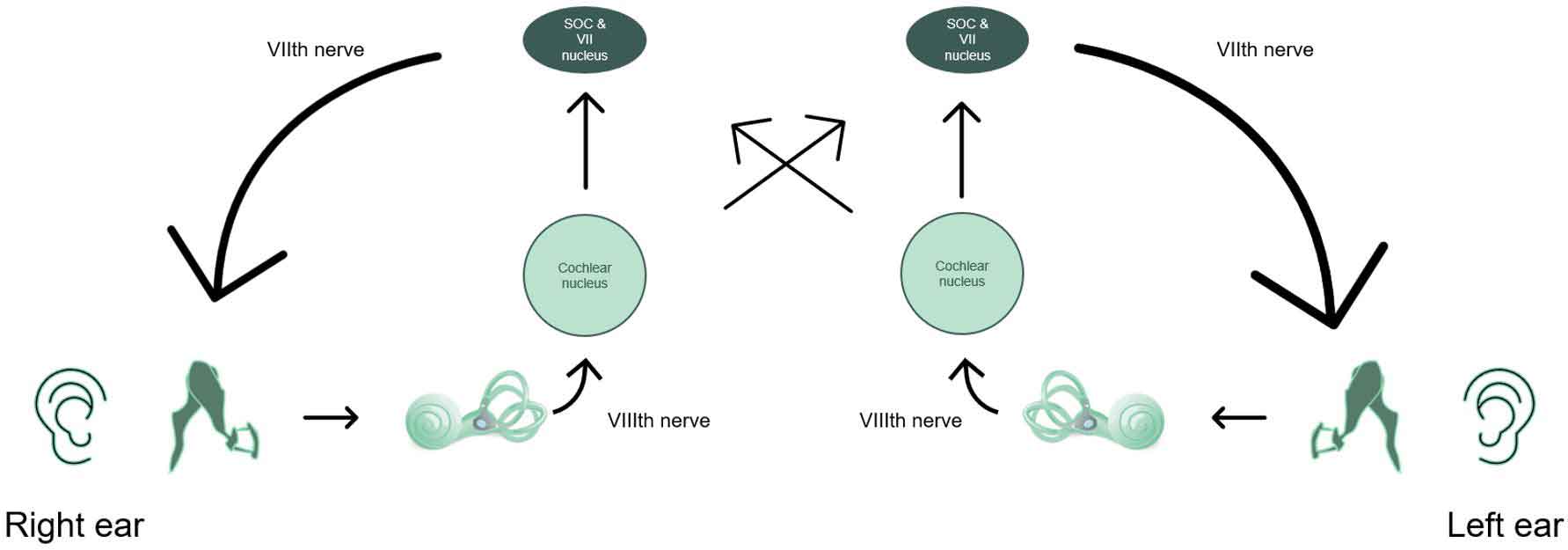 Acoustic reflex arc, shown as a pathway along the following: outer ear, middle ear, cochlea, eight cranial nerve, cochlear nucleus, facial motor nucleus, and the superior olivary complex.