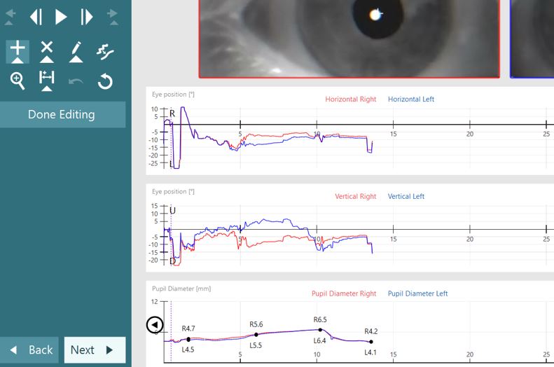 The Pupil Diameter graph is below the horizontal and vertical eye tracing graphs. It has mm as a function of time for the right and left eyes. In this example, the user has added four measurements in the 0 to 15 second range.