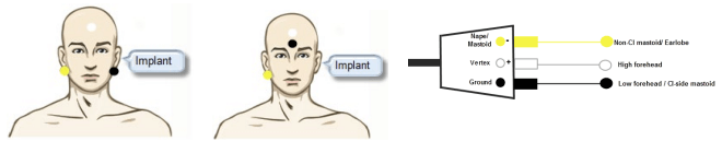 eABR-electrode-placement Man with to options for electrode placement displayed. In the first example, the man has an electrode on the non CI mastoid, the vertex electrode on the high forehead, and the ground elecrode on the CI mastoid. In the second example, the man has an electrode on the non CI mastoid, the vertex electrode on the high forehead, and the ground electrode on the low forehead.