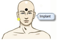 Alternative-eABR-electrode-placement