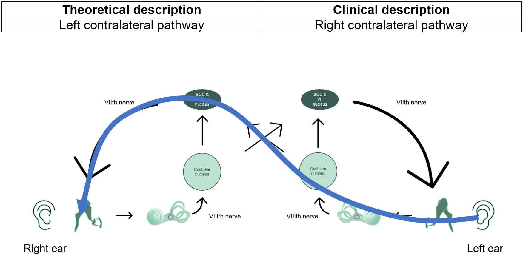 Contralateral pathway showed with blue line for stimulus in left ear and probe in right ear. The theoretical description is the left contralateral pathway, whereas the clinical description is the right contralateral pathway.