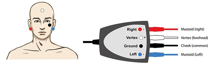 Electrode-placement-ASSR Man with right electrode on the right mastoid, vertex electrode on the vertex, ground electrode on the cheek, and left electrode on the left mastoid. Right electrode is red. Vertex electrode is white. Ground electrode is black. Left electrode is blue.