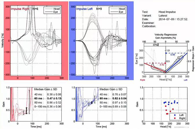 Velocity and gain data graphs showing vHIT results. The velocity graphs for the right-left impulses show head and eye curves with degrees as a function of seconds. The head and eye movements match poorly in the rightward direction but match within normal range in the leftward direction. In the right direction, the median gain at 60 milliseconds is 0.47. In the left direction, the median gain at 60 milliseconds is 0.82.