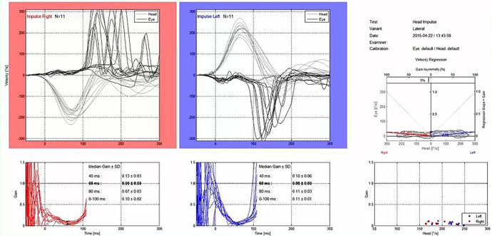 Velocity and gain data graphs showing vHIT results. The velocity graphs for the right-left impulses show head and eye curves with degrees as a function of seconds. The head and eye movements match poorly in both directions. The median gain at 60 milliseconds is 0.05 in both directions.