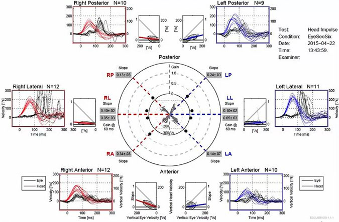 Median gain at 60 milliseconds is 0.13 for right posterior, 0.05 for right lateral, 0.34 for right anterior, 0.24 for left posterior, 0.05 for left lateral, and 0.14 for left anterior. All below the normative cutoff of 0.8.