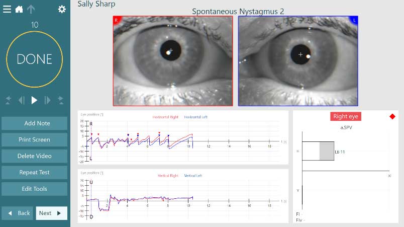 Results overview for spontaneous nystagmus. Left-beating nystagmus with an average slow phase velocity of 11.