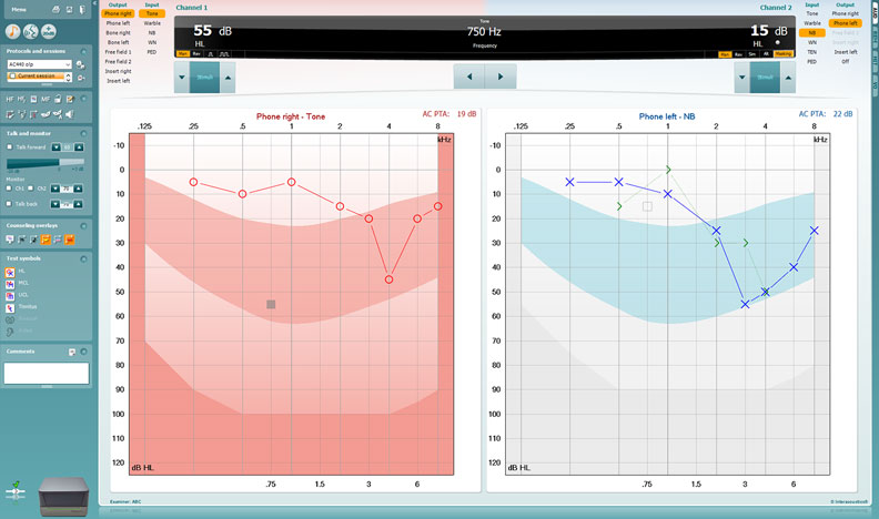 Graphs with dB HL as a function of kHz. The results for the right ear show the following thresholds: 5 dB HL at 0.25 kHz, 10 dB HL at 0.5 kHz, 5 dB HL at 1 kHz, 15 dB HL at 2 kHz, 20 dB HL at 3 kHz, 45 dB HL at 4 kHz, 20 dB HL at 6 kHz, and 15 dB HL at 8 kHz. The results for the left ear show the following thresholds: 5 dB HL at 0.25 kHz, 5 dB HL at 0.5 kHz, 10 dB HL at 1 kHz, 25 dB HL at 2 kHz, 55 dB HL at 3 kHz, 50 dB HL at 4 kHz, 40 dB HL at 6 kHz, and 25 dB HL at 8 kHz.