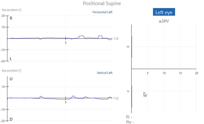 Graphs with eye position in degrees as a function of time in seconds. No horizontal or vertical nystagmus, visible by almost flat traces close to zero degrees. Another graph showing the average slow phase velocity also shows no horizontal or vertical nystagmus.