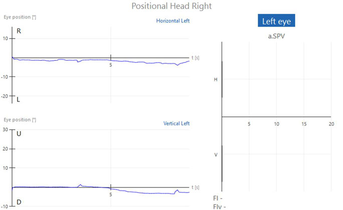 Graphs with eye position in degrees as a function of time in seconds. No horizontal or vertical nystagmus, visible by almost flat traces close to zero degrees. Another graph showing the average slow phase velocity also shows no horizontal or vertical nystagmus.