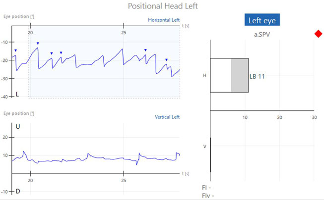Graphs with eye position in degrees as a function of time in seconds. Six recorded beats of horizontal, left-beating nystagmus, yielding a left-beating nystagmus with an average slow phase velocity of 11. This is above the normal range of 0 to 6.