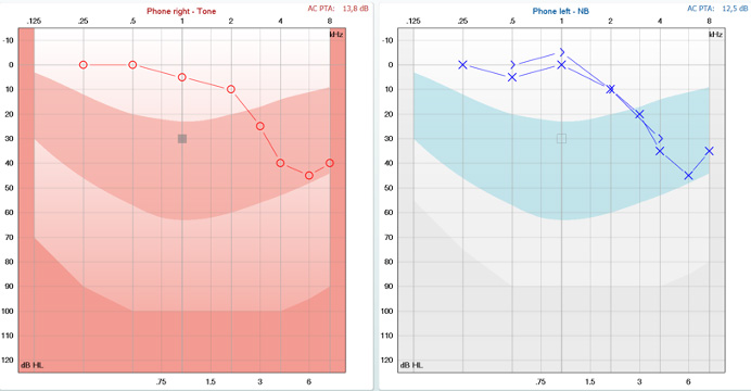 For both ears, the threshold increases as the frequency increases, reaching thresholds in the 20 to 45 dB range from 3 kHz and above.