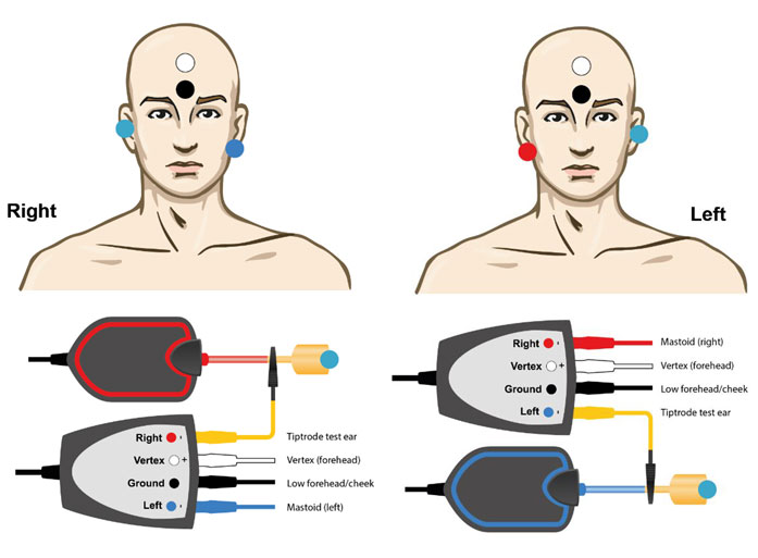 TipTrode in test ear, with electrode on opposite mastoid, forehead, and ground electrode on low forehead.