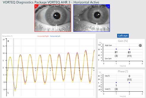 Horizontal active subtest screen for VORTEQ active head rotation. 81% gain at 1 and 2 hz. 1 degree phase lag at 1 hz. 0 degree phase at 2 hz. Smooth sinusoids for eye position that follow the target position nicely.