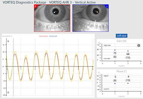 Vertical active subtest screen for VORTEQ active head rotation. 75% gain at 1 hz and 68% gain at 2 hz. 5 degree phase lead at 1 hz. 4 degree phase lead at 2 hz. Smooth sinusoids for eye position that fall a bit short of the target position.