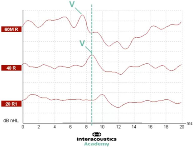 Graph with dB nHL as a function of milliseconds. A vertical, dotted line at 8.5 milliseconds shows the latency of wave V for the 40 dB nHL intensity level.