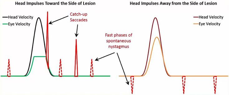 Eye and head velocity tracings with fast phases of spontaneous nystagmus occurring before and after the head impulses. The spontaneous nystagmus velocities are smaller than the catch-up saccades, pointing in the same direction for head impulses toward the side of lesion and pointing in the opposite direction for head impulses away from the side of lesion.