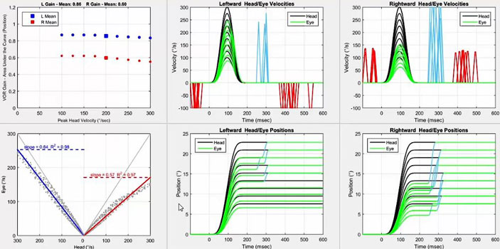 Six graphs in total. Firstly, a graph with VOR gain as a function of peak head velocity in degrees per second. For the left impulses, the gain is below 1 but above the cutoff of 0.8 for all head velocities. For the right impulses, the gain hovers about 0.6 for all head velocities. Secondly, a graph with eye velocity in degrees per second as a function of head velocity in degrees per second. To show data for both leftward and rightward impulses, the x-axis is split into two identical portions, with a head velocity of zero degrees per second in the middle, ranging up to 300 degrees per second on either side for each head impulse direction. Thus, a VOR gain of 1 would yield a line where head and eye velocity were always equal. For the left impulses, the scatter plot hovers somewhat below this line, yielding a slope of 0.84. For the right impulses, the scatter plot is way below this line, yielding a slope of 0.57. Thirdly and fourthly, we have the velocity and position graphs for the leftward impulses. In the velocity graph, the head and eye movements are plotted with velocity, in degrees per second, as a function of time, in milliseconds. For velocity, the peak eye velocities match nicely with the peak head velocities up to 250 degrees per second. Quite significant overt saccades occur at 250 to 300 milliseconds. Fast phases of spontaneous nystagmus in the opposite direction are visible before and after the head impulse. In the position graph, the head and eye movements are plotted with position, in degrees, as a function of time, in milliseconds. For position, the eye positions immediately lag behind the head positions, with overt saccades required to match the head positions at 15 degrees and above. Fifthly and sixthly, we have the velocity and position graphs for the rightward impulses. For velocity, the peak eye velocities only match nicely with the peak head velocities up to 150 degrees per second. High-velocity overt saccades occur at 300 milliseconds. Fast phases of spontaneous nystagmus in the same direction are visible before and after the head impulse. For position, overt saccades are required to match all head positions.
