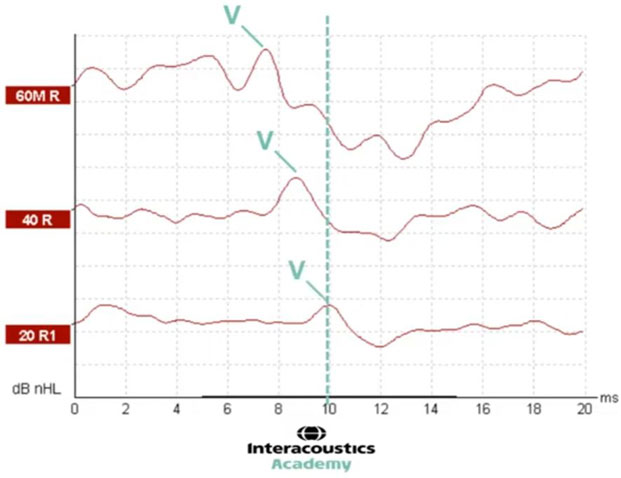 Graph with dB nHL as a function of milliseconds. A vertical, dotted line at 10 milliseconds shows the latency of wave V for the 20 dB nHL intensity level.