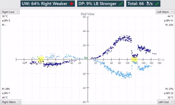 Pod view showing four quadrants for the right cool, right warm, left warm, and left cool irrigations. In each quadrant, there is a scatter plot showing data for slow phase velocity (SPV) as a function of time. The responses for the right side are much smaller than the left side. The average SPV values are as follows. Right cool equal 5. Right warm equal 7. Left warm equal 31. Left cool equal 23.