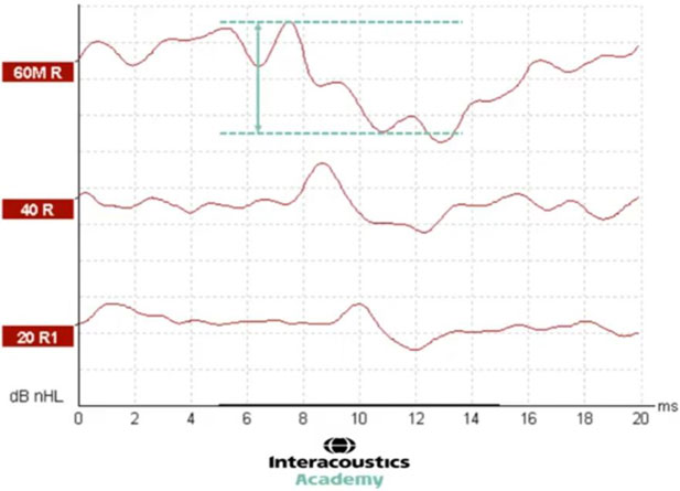 Graph with dB nHL as a function of milliseconds. Two horizontal, dotted lines show the peak of wave V and the following trough. An arrow between these two dotted lines shows the distance, which is the amplitude. The amplitude is roughly 15 dB nHL.