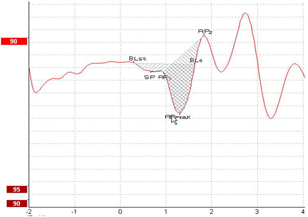 Baseline start at about 0.4 milliseconds. Summating potential and AP1 shortly before 1 millisecond. Action potential peak at about 1.3 milliseconds. Baseline end at about 1.6 milliseconds. AP2 at about 1.8 milliseconds. The software has sketched the areas between baseline start to baseline end and AP1 to AP2, respectively.