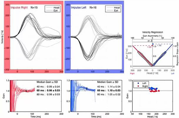 Velocity and gain data graphs showing vHIT results. The velocity graphs for the right-left impulses show head and eye curves with degrees as a function of seconds. The head and eye movements match nicely in both directions, with a peak velocity of about 200 degrees just short of 100 milliseconds. In the right direction, the median gain at 60 milliseconds is 0.98. In the left direction, the median gain at 60 milliseconds is 1.10.