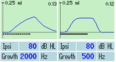 Reflex morphology for acoustic reflexes elicited with pulsed and continuous stimuli. With the pulsed stimulus, the deflection value has a sharp peak. With the continuous stimulus, the deflection value has a flat peak.