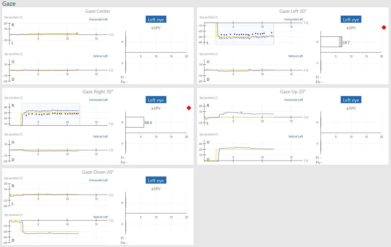 Gaze results overview, including gaze center, gaze right 30 degrees, gaze down 20 degrees, gaze left 30 degrees, and gaze up 20 degrees. For gaze right and left 30 degrees, horizontal left, the blue curve for eye position is jagged, indicating nystagmus. For right 30 degrees, the average slow phase velocity of the nystagmus is 6. For left 30 degrees, the average slow phase velocity of the nystagmus is 7. The nystagmus peaks are marked with a blue triangle, and the failed subtests are flagged with a red diamond.