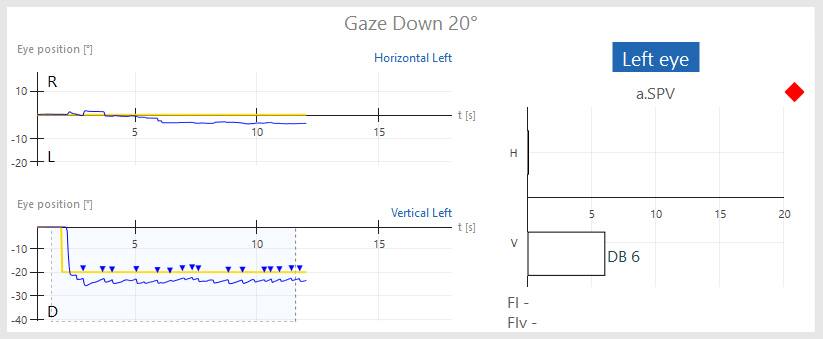 Gaze results overview for gaze down 20 degrees. For vertical left, the blue curve for eye position is jagged, indicating nystagmus. The average slow phase velocity of the nystagmus is 6. The nystagmus peaks are marked with a blue triangle, and the subtest is flagged with a red diamond.