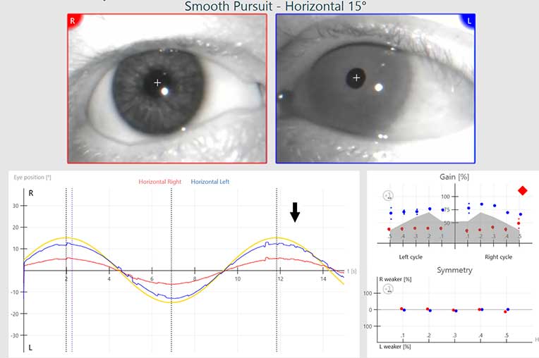 Smooth pursuit software screen with prosthetic eye on the right side