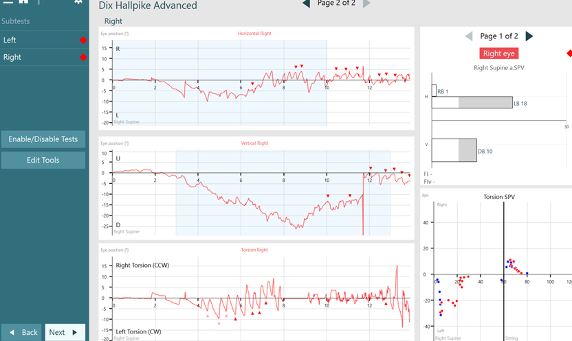 All eye position graphs display abnormal amounts of beating nystagmus.