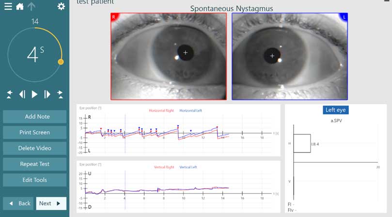 Test screen during data collection, with a video image of the patient’s eyes and the nystagmus tracings for horizontal and vertical eye movements.