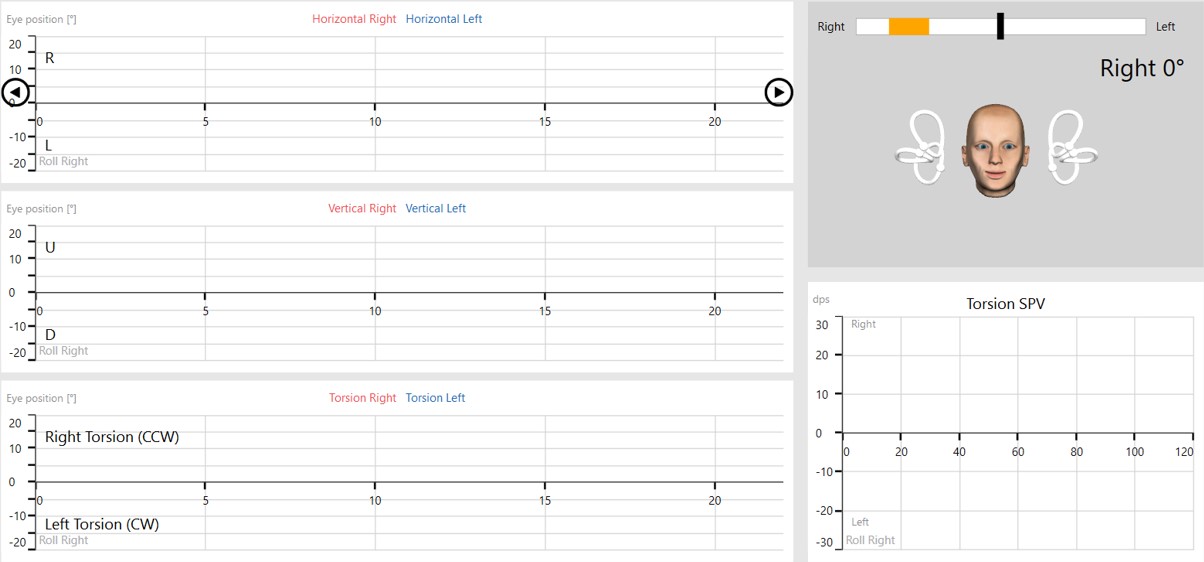 Eye position graphs in degrees as a function of time for horizontal, vertical, and torsion right and left. There is also a 3D head model displaying the current head position and in which position the head should be turned. Finally, there is a torsion SPV graph.