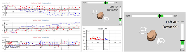 Software screen during real-time data collection. In addition to the eye tracing graphs for horizontal and vertical eye movements, there is also an eye tracing graph for torsional eye movements. The 3D head model is also displayed showing the patient in a Dix-Hallpike left position.