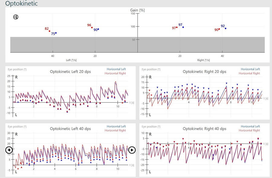 Normal-optokinetic-nystagmus-results Results overview for right and left optokinetic nystagmus results, for 20 dps and 40 dps. For optokinetic left 20 dps, left horizontal gain is 90%, right horizontal gain is 96%, and eye position hovers between -10 to 20 degrees. For optokinetic left 40 dps, left horizontal gain is 75%, right horizontal gain is 82%, and eye position hovers between -5 to 20 degrees. For optokinetic right 20 dps, left horizontal gain is 97%, right horizontal gain is 97%, and eye position hovers between -10 to 15 degrees. For optokinetic right 40 dps, left horizontal gain is 92%, right horizontal gain is 90%, and eye position hovers between -20 to 5 degrees.