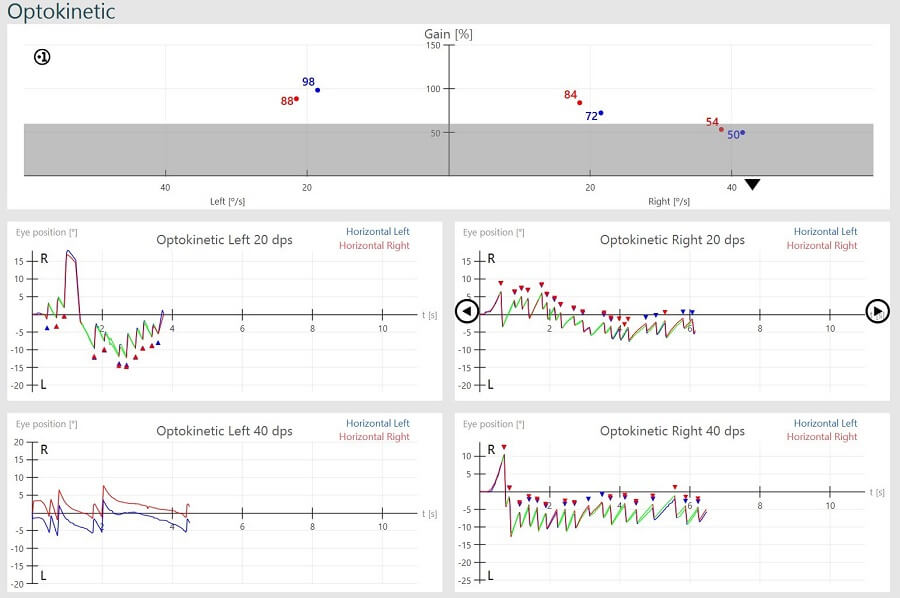 Abnormal-optokinetic-nystagmus-results Results overview for right and left optokinetic nystagmus results, for 20 dps and 40 dps. For optokinetic left 20 dps, left horizontal gain is 98%, right horizontal gain is 88%, and eye position hovers between -15 to 20 degrees. For optokinetic left 40 dps, no gains are calculated. For optokinetic right 20 dps, left horizontal gain is 72%, right horizontal gain is 84%, and eye position hovers between -10 to 10 degrees. For optokinetic right 40 dps, left horizontal gain is 50%, right horizontal gain is 54%, and eye position hovers between -15 to 10 degrees.