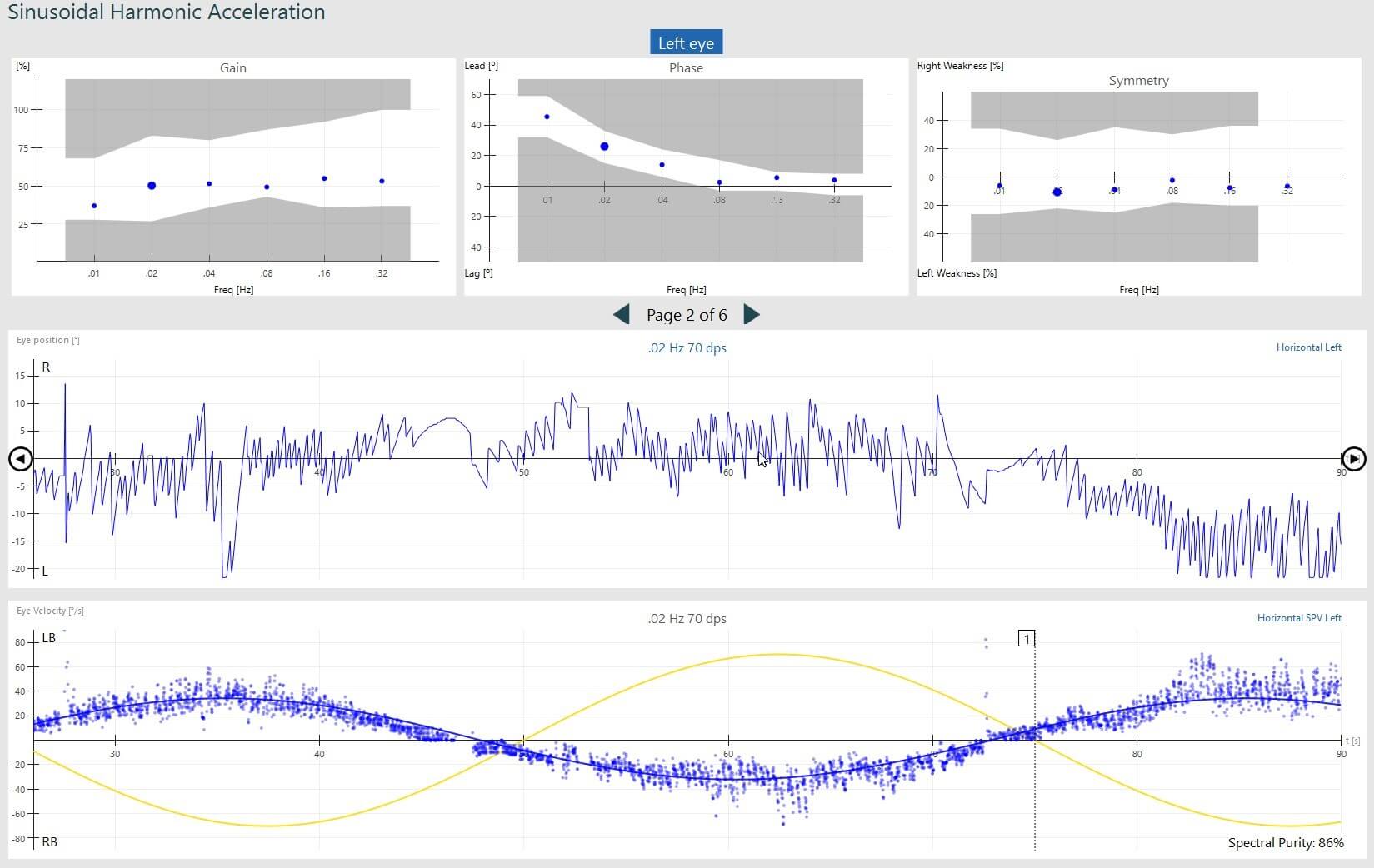 Normal SHA test results, displaying gain, phase, symmetry, eye position and eye velocity.
