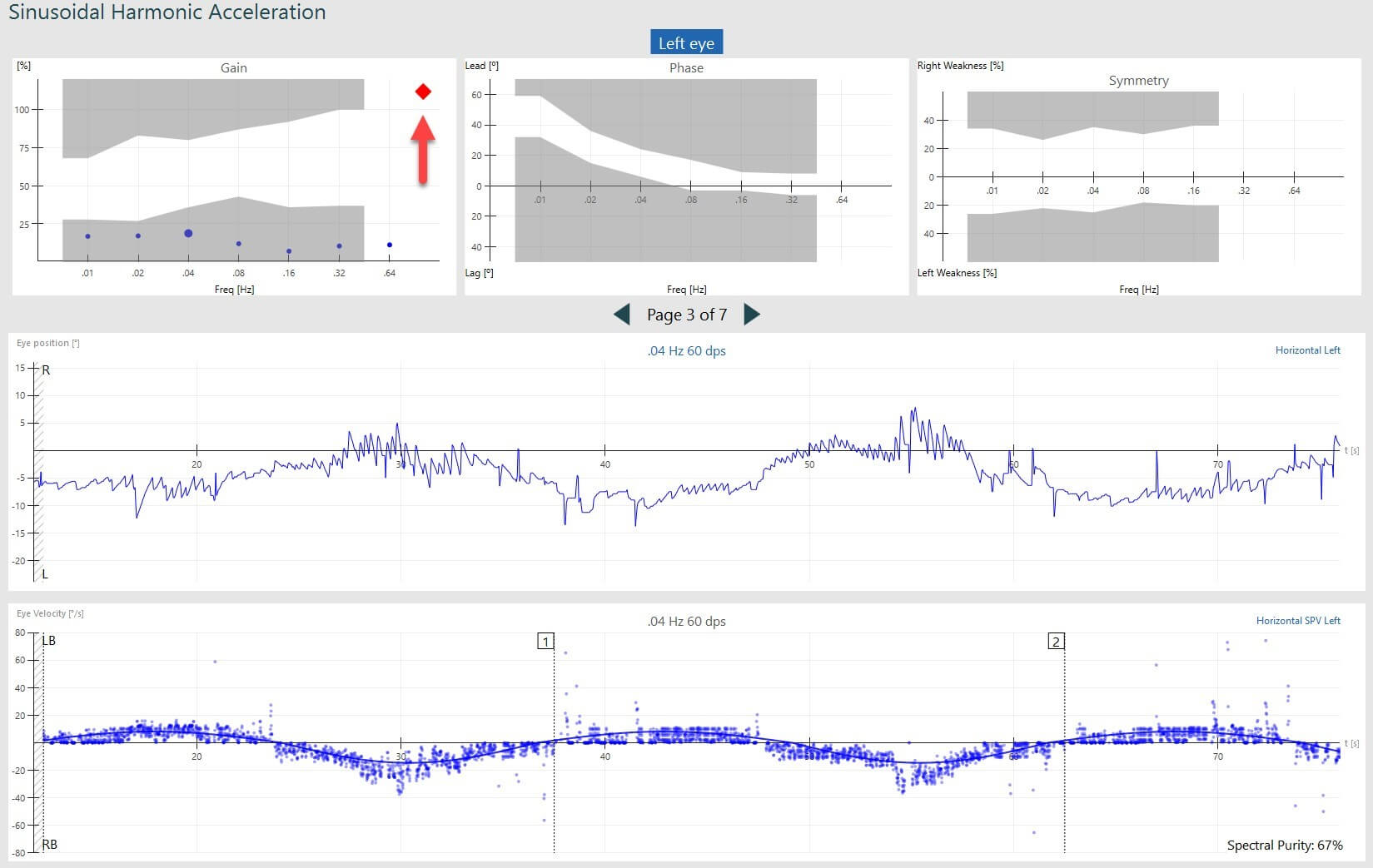 Asymmetric SHA response. Reduced VOR gain for all frequencies, visible with dots in a grey shaded area.