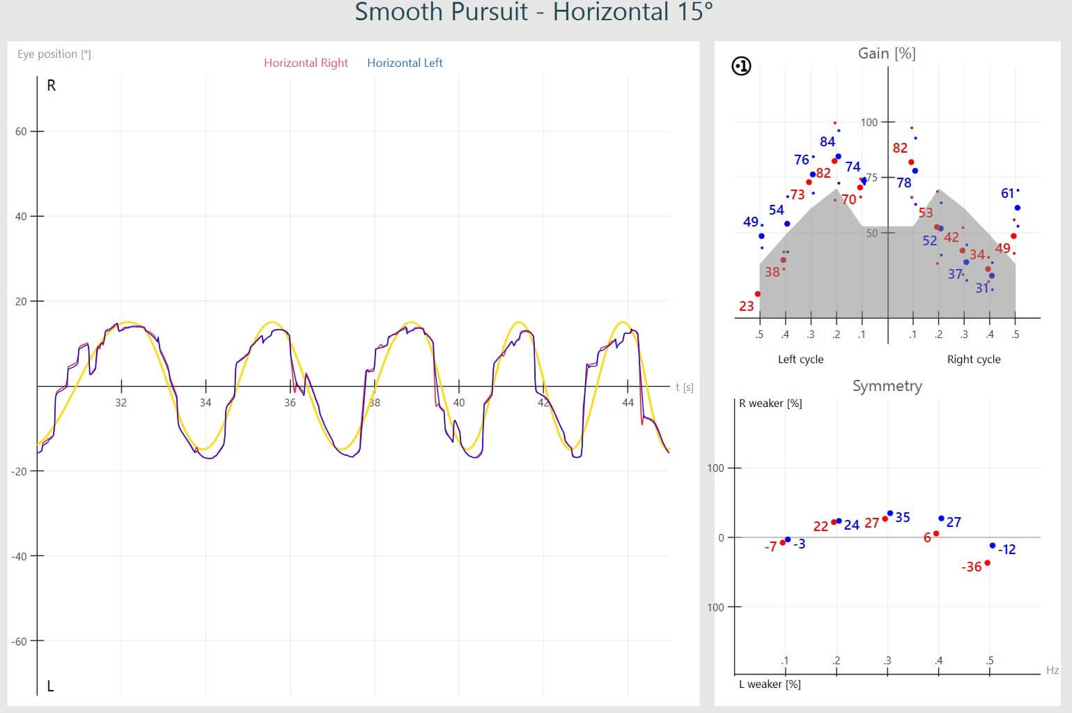 Abnormal smooth pursuit results, including a jagged sinusoid for eye position, gain results in the grey, abnormal region, and abnormal symmetry.
