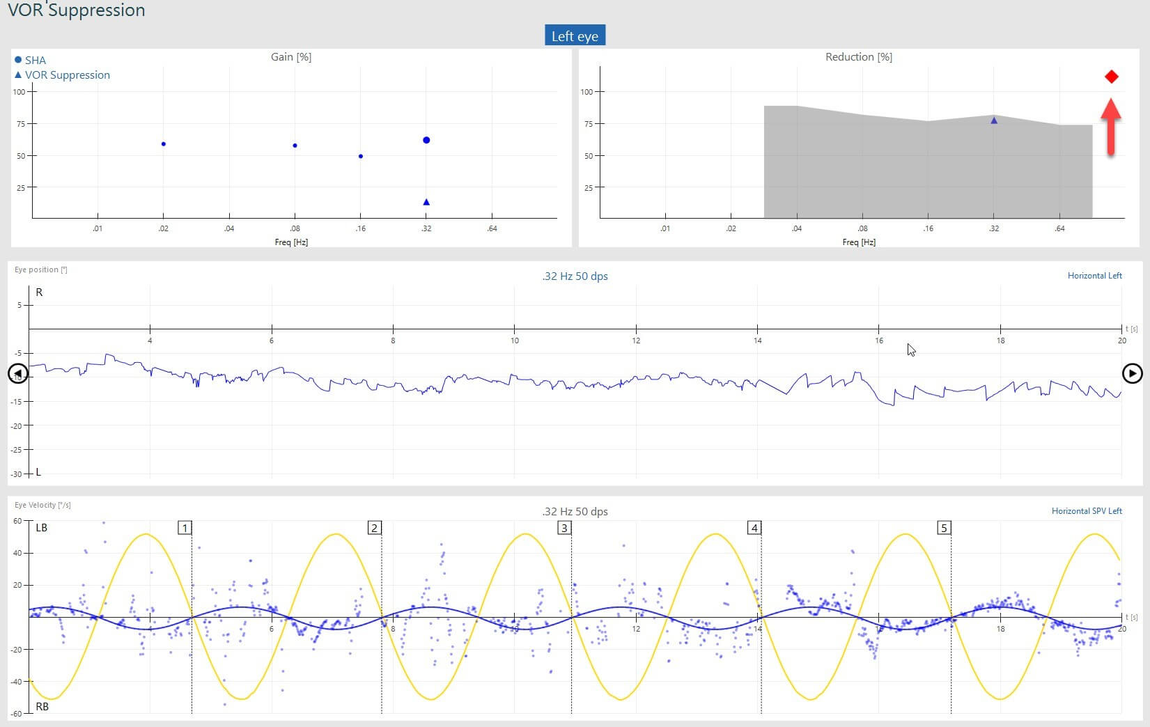 VOR suppression results screen, showing abnormal reduction value, visible with result located in grey shaded area.